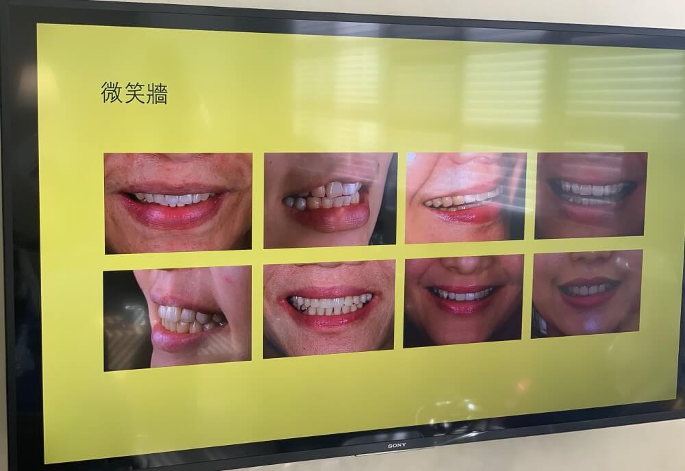 微笑牆 樂庭牙醫 台中植牙專家 微創植牙 水雷射植牙